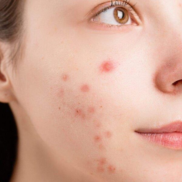 Buy dark spot correction essential oil blend